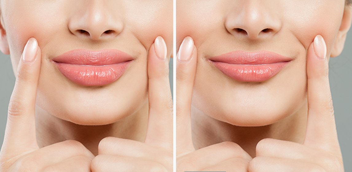 الشفايف الروسية بالفيلر