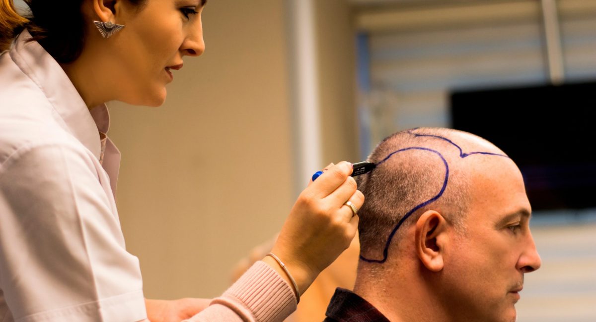 عملية زراعة الشعر 