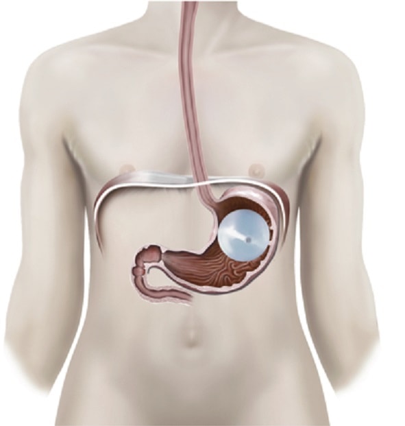 بالون المعدة الأمريكي