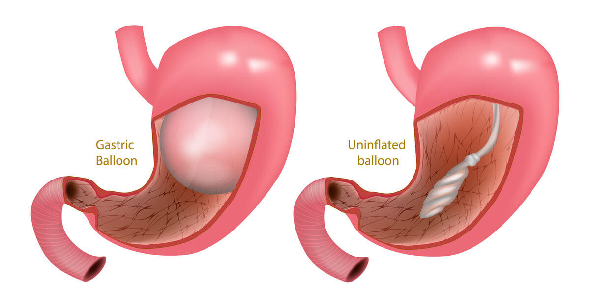 بالون المعدة الفرنسي