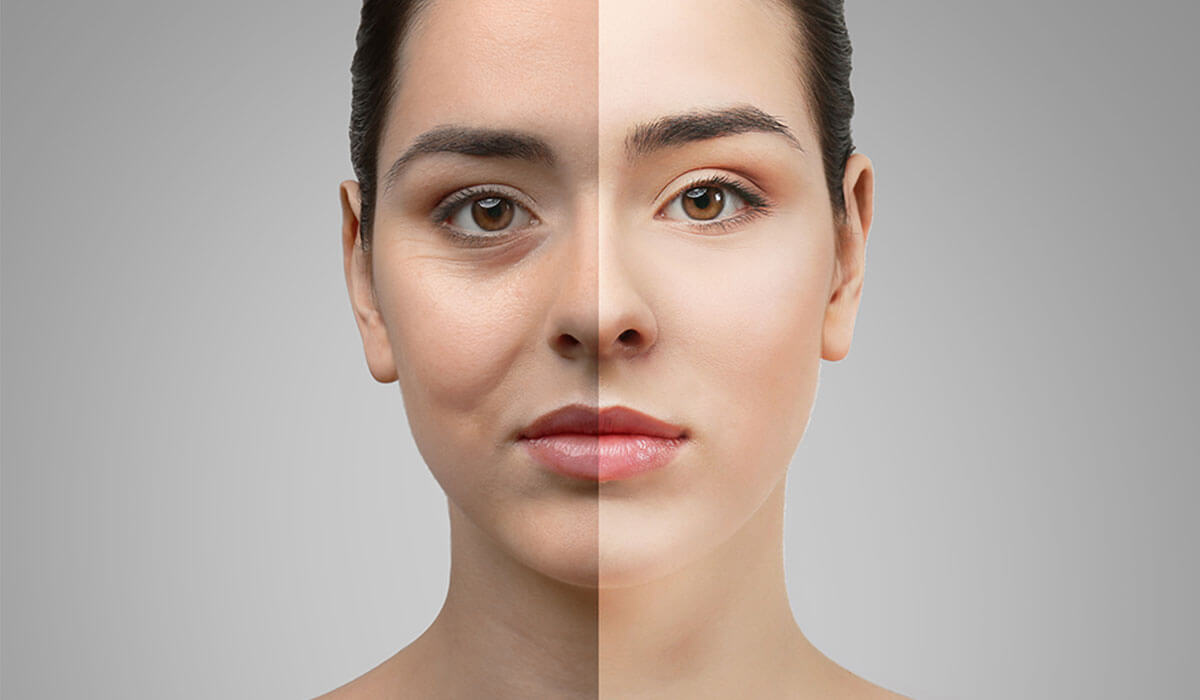 حقن الدهون أسفل العين