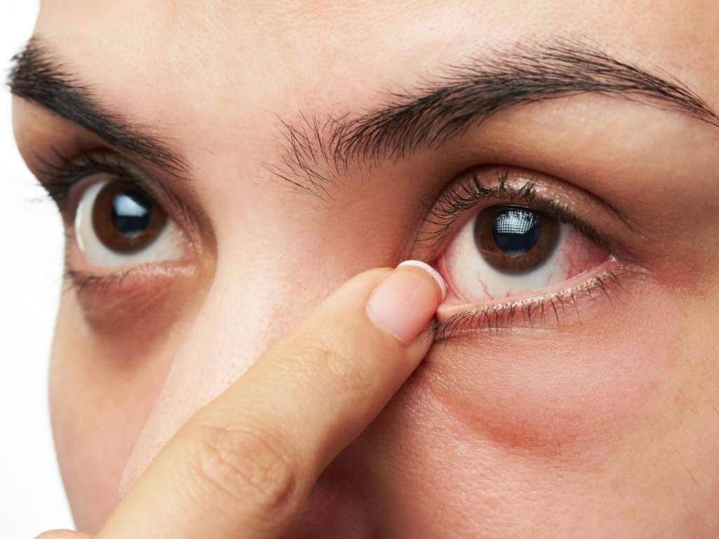 علاج انتفاخ جفن العين السفلي