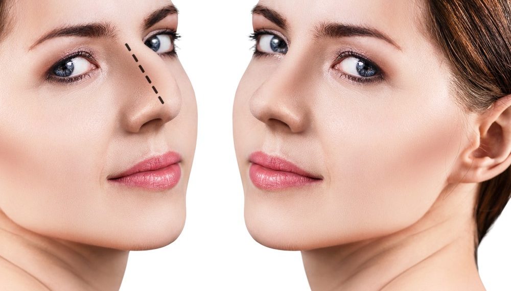 لصقات الانف بعد عملية التجميل